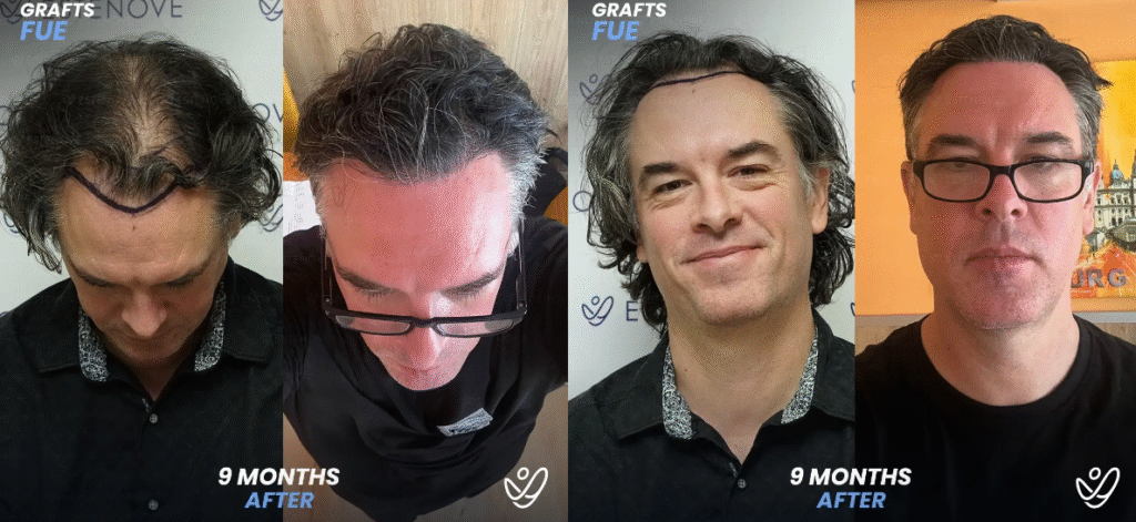 Four side-by-side photos show a man’s hair transplant progress over nine months, with visible hairline improvement and fuller hair from different angles. The words "Grafts FUE" and "9 months after" appear in each image.